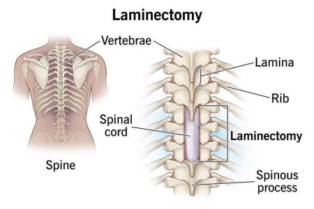 Laminectomy