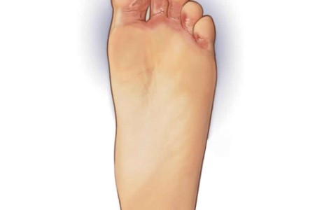 Athlete’s Foot (Tinea Pedis)