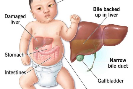 Biliary Atresia