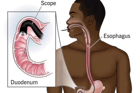 Endoscopy