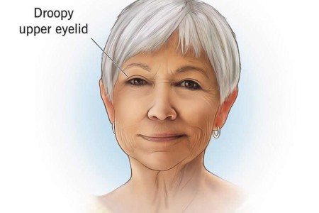 Ptosis (Droopy Eyelid)