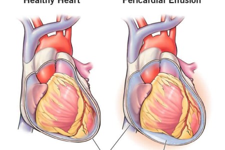 Pericardial Effusion