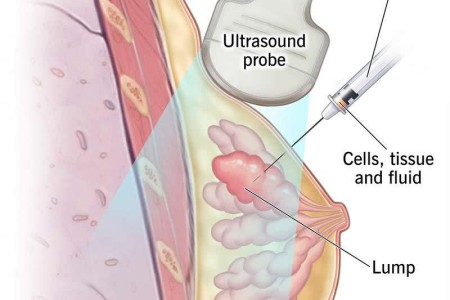 Fine-Needle Aspiration (FNA)