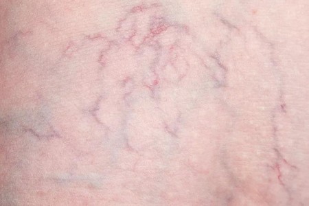 What’s the Difference Between Varicose Veins and Spider Veins?