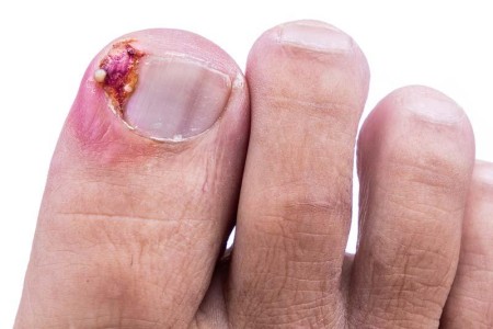 Ingrown Toenails