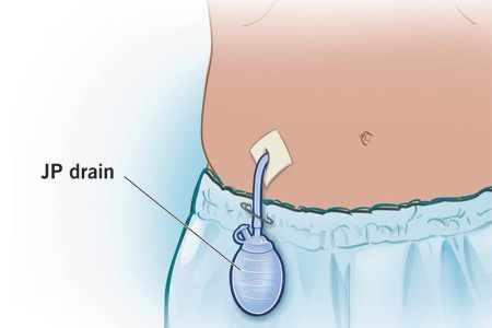 Jackson-Pratt (JP) Drain