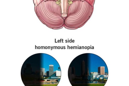 Homonymous Hemianopia (Homonymous Hemianopsia)