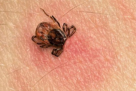 Tick Bites