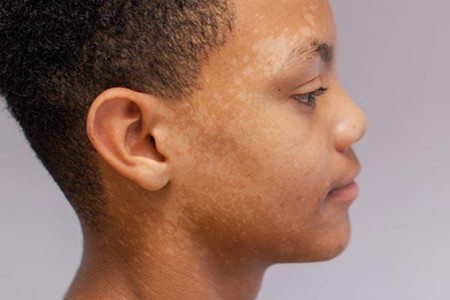 Tinea Versicolor