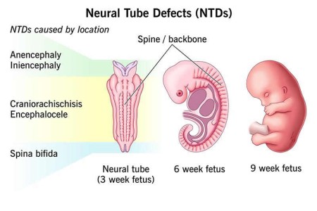 Neural Tube Defects (NTD)