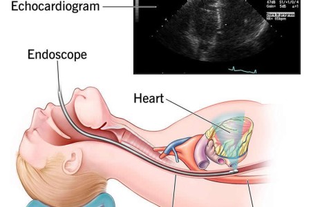 Transesophageal Echocardiogram (TEE)