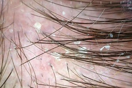 Seborrheic Dermatitis