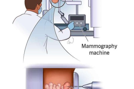 Stereotactic Breast Biopsy