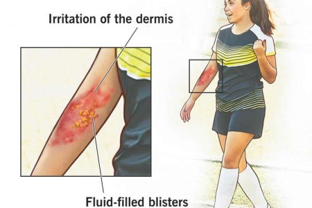 Weeping Eczema