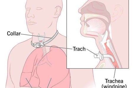 Tracheostomy