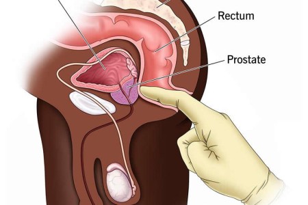 Prostate Exam