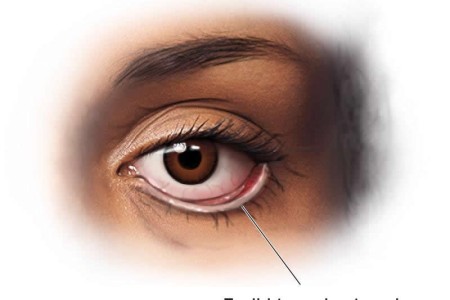 Ectropion