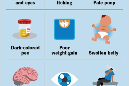Alagille Syndrome