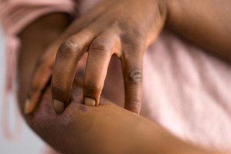 How Psoriasis Affects Black People and People of Color