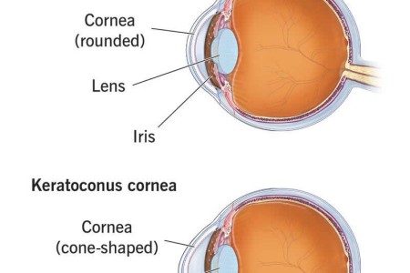 Keratoconus