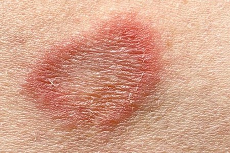 Ringworm