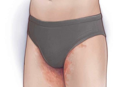 Jock Itch (Tinea Cruris)