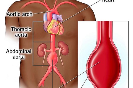 Abdominal Aortic Aneurysm