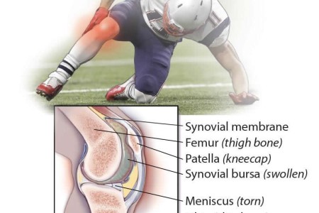 Joint Effusion (Swollen Joint)