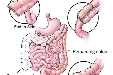 Anastomosis