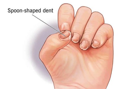 Koilonychia (Spoon Nails)