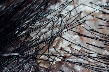Dry Scalp