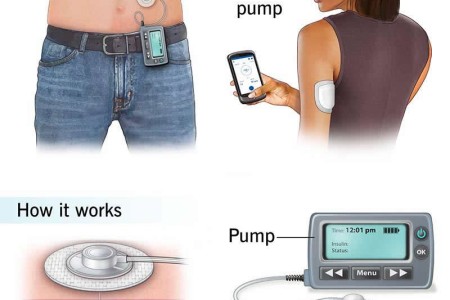Insulin Pumps