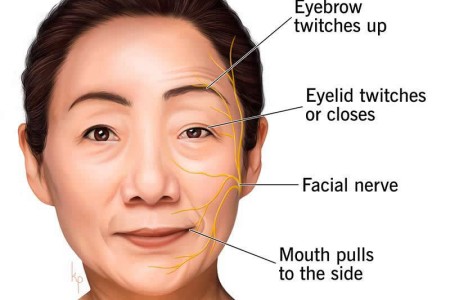 Hemifacial Spasm (Face Twitching)