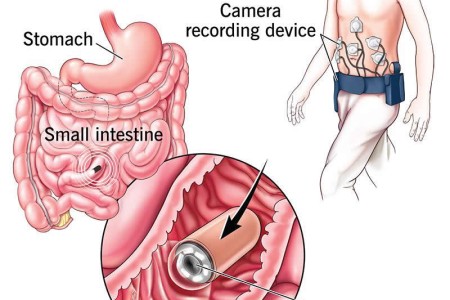 Capsule Endoscopy