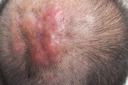 Dermatofibrosarcoma Protuberans (DFSP)