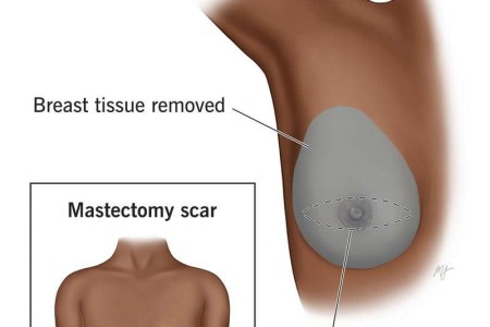 Mastectomy