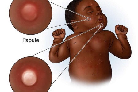 Baby Acne