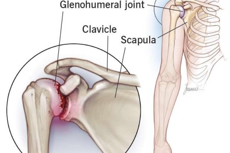 Shoulder Arthritis