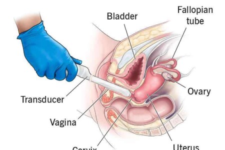 Transvaginal Ultrasound