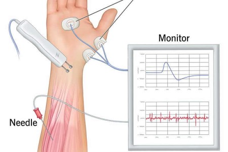 EMG (Electromyography)