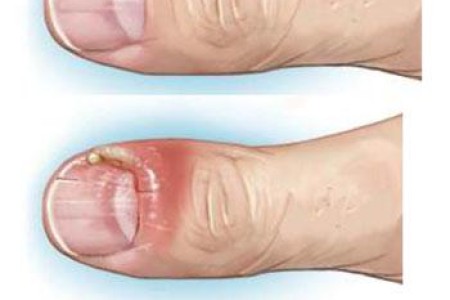 Nail Infection (Paronychia)