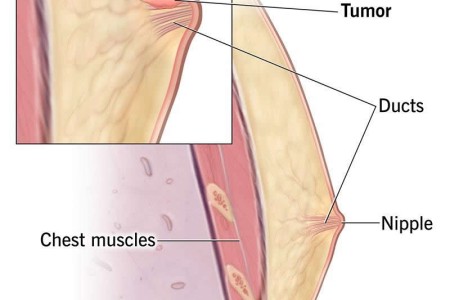 Male Breast Cancer