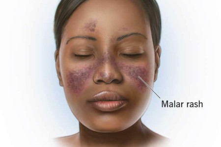 Lupus Rash