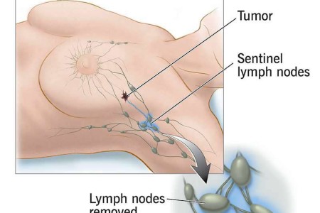 Sentinel Node Biopsy