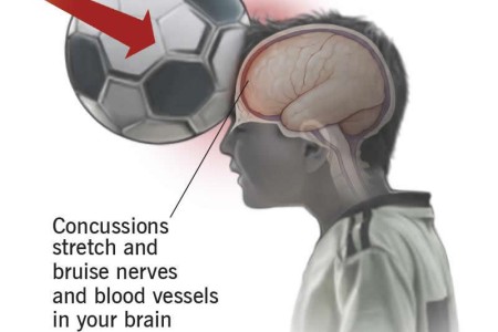 Concussion