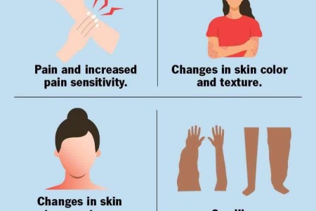Complex Regional Pain Syndrome (CRPS)