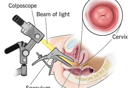 Colposcopy