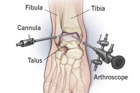 Ankle Arthroscopy