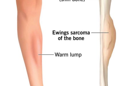 Ewing Sarcoma