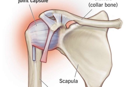 Frozen Shoulder (Adhesive Capsulitis)